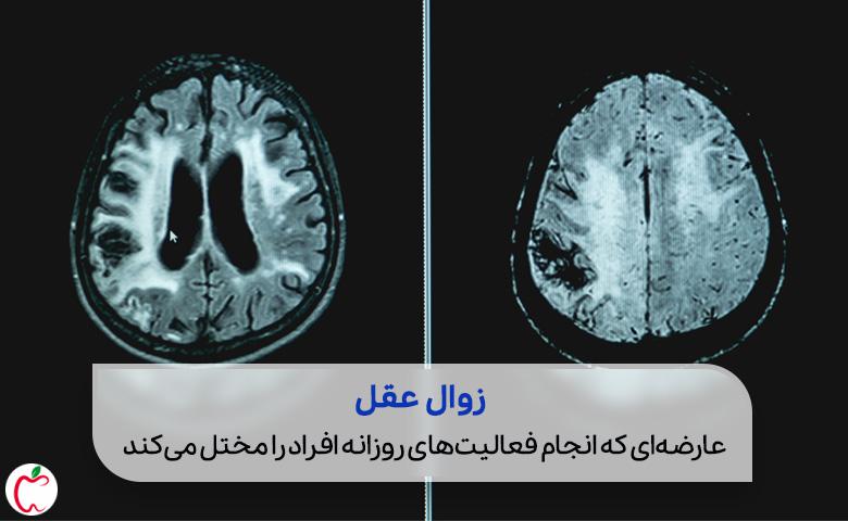 توصیه محققان به زنان برای کاهش احتمال زوال عقل توصیه محققان به زنان برای کاهش احتمال زوال عقل