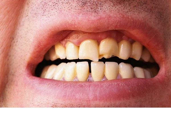 هفت عادت مضر برای سلامت دندانها هفت عادت مضر برای سلامت دندانها